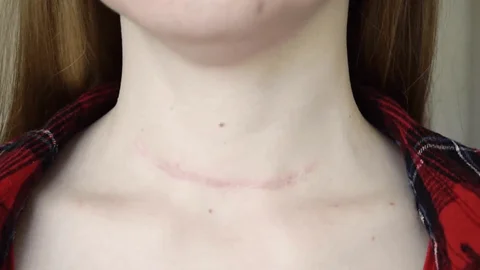 How Long Does Neck Tightness Last After Thyroidectomy?