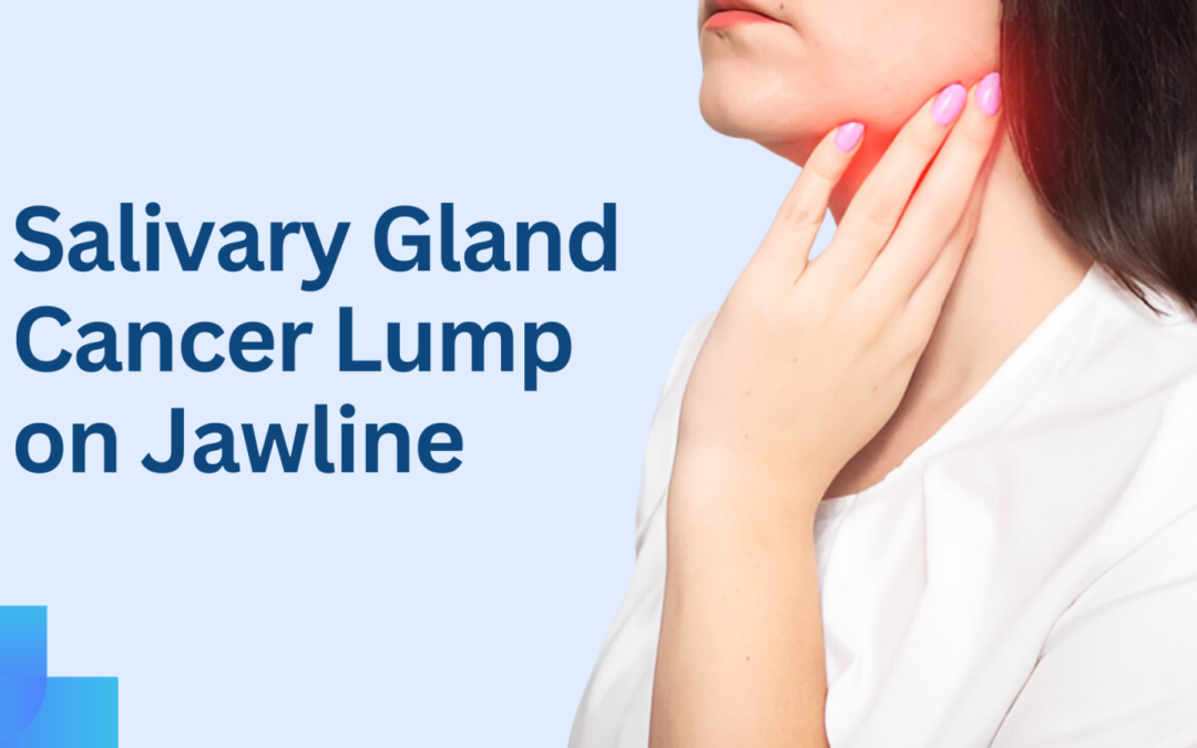 Salivary Gland Cancer Lump on Jawline